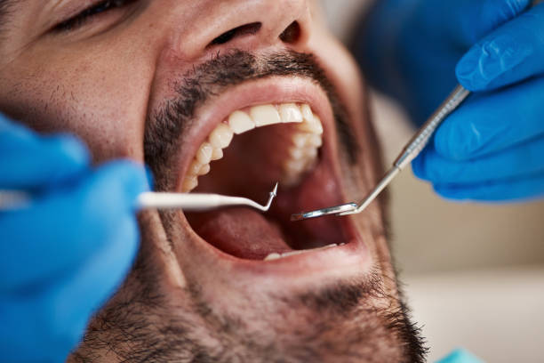 Best Emergency Dentist for Lost Fillings or Crowns in Copeland, OK